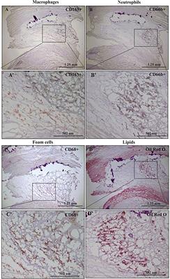 Giant phagocytes (Gφ) and neutrophil-macrophage hybrids in human carotid atherosclerotic plaques – An activated phenotype